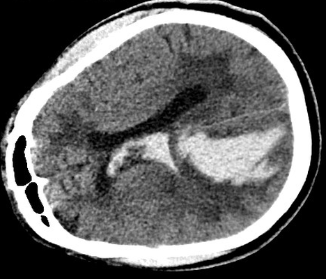 intracerebral hemorrhage